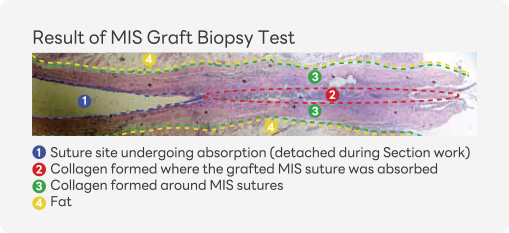 Result of MIS Graft Biopsy Test