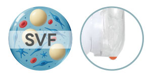 What is SVF 